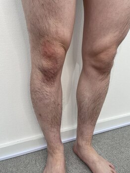 ロイビー(loeyB)/脱毛前