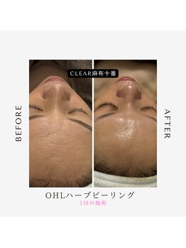 クリア 麻布十番(CLEAR)/OHLハーブピーリング　妊娠中
