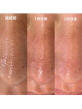 シャイン(Shine)/韓国式3D毛穴洗浄