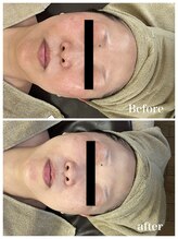 ジャスミン(Jasmin)/たるみ改善コース