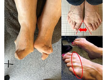 レメディ/外反などの足のトラブル