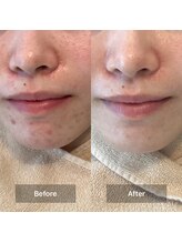 モカ 天王寺店(MOKA)/剥離2回　ホホニキビケア　毛穴