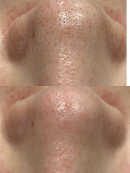 ダリアビューティー(Dahlia Beauty)/ハイドラbefore after