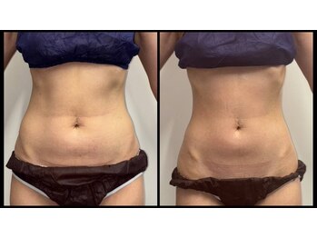 アイリーボーテ 東大阪(アイリーBEAUTE)/痩身　ノンFクリーム使用