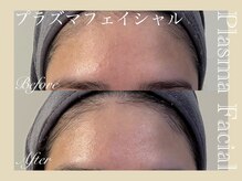 ミリュール(Millule)/プラズマフェイシャル