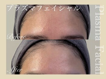 ミリュール(Millule)/プラズマフェイシャル