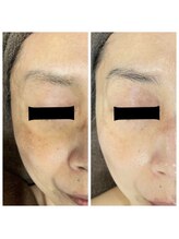 ジャスミン(Jasmin)/プラペン×幹細胞