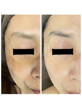 ジャスミン(Jasmin)/プラペン×幹細胞