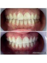 ラペカ(Lapeca)/セルフホワイトニング名古屋