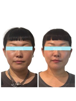 マニーク(Maniik)の写真/頬骨・エラ張りをすっきり整え四角い顔から理想の卵型へ♪優しい施術で自分史上最高の小顔に