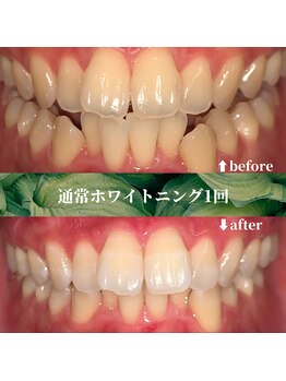 フタバ 天神大名店(futaba)/ホワイトニング初回before after