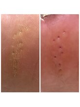 ドクターネイル爪革命 十条店/魚の目ケア