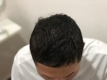 フェイシャル専門サロン サロン ド ウイッシュ/丸亀【頭髪促進】エアバリ頭髪