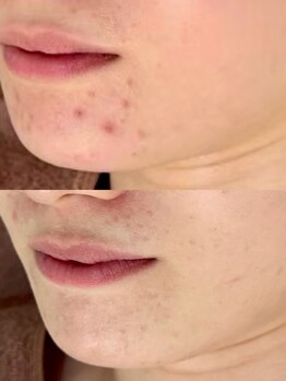 アルムダアクア 天王寺店(Aleumda AQUA)/ハーブピーリング/大阪/天王寺