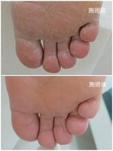 レフス 北参道店(REFUSS)/本格角質ケア