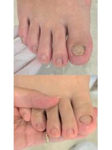 ハビッツ(habits)/親指の爪だけでも