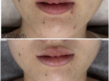 アンリミット 鹿児島天文館店(Une limit)/乳酸菌ピーリング