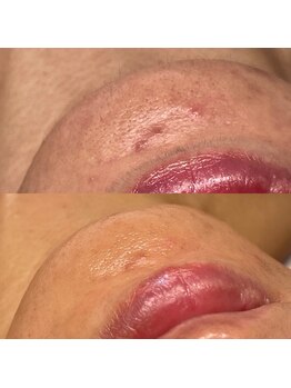 オフモード(OffMode)/口周りの毛もフェイスワックス♪