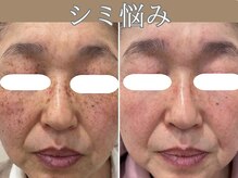 ハウオリ(HAUOLI)/シミ集中ケア