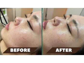 メディカルサロン フィオレ(fiore)/雪美人プレミアムコース