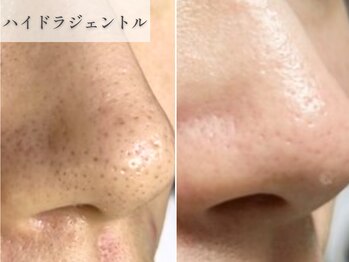 南青山コスメクリニック スキンラボ 横浜(SKIN LAB)/ハイドラジェントル