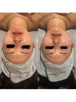 ア ビアントー(A ビアントー)の写真/潤い小顔を目指すケア。保湿と毛穴を整え5年前のお肌に戻ってみませんか♪ツヤ肌へ◎