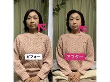 整体院りょう 高槻市/#ほうれい線 #たるみ改善