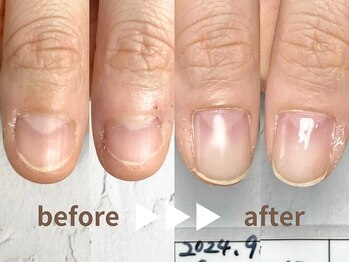 自爪育成で別人の手に♪親指