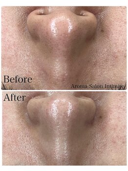 アンティミテ(Intimite)/毛穴洗浄1回の変化