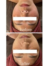 ミルティー(Myrtille)/ララピール