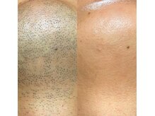 エル ブランシュ(Ailes blanches)/メンズ髭脱毛