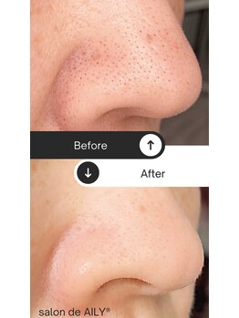 サロンドアイリー(salon de AILY)の写真/毛穴洗浄で目に見えてごっそり！たるみ毛穴もザラつきも解消へ◎LDMで引き締め効果を実感！
