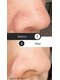サロンドアイリー(salon de AILY)の写真/毛穴洗浄で目に見えてごっそり！たるみ毛穴もザラつきも解消へ◎LDMで引き締め効果を実感！