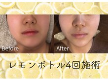 美成(vise)の雰囲気（最新小顔ケア | レモンボトル）