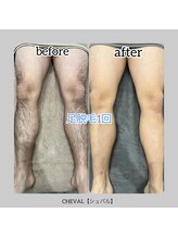 シュバル(CHEVAL)/メンズ大人気【足脱毛】