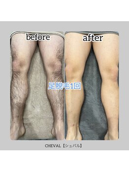 シュバル(CHEVAL)/メンズ大人気【足脱毛】