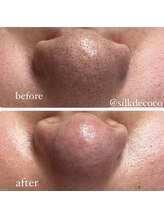 シルク ド ココ(Silk de Coco)/ハイドロピーリング