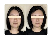 ジョワ 北堀江(joie)/小顔矯正&毛穴洗浄 ニキビ/エラ