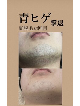 ヴィアージュ/青ヒゲ撃退