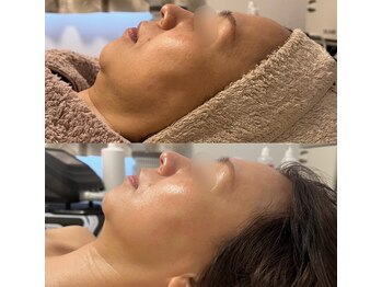 クリアビューティー(CLEAR BEAUTY)/小顔メニュー