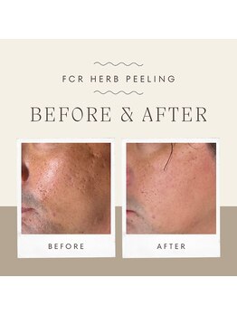 サロンアン(Salon an)/肌質改善にFCRハーブピーリング