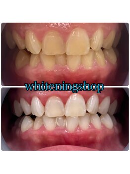 ホワイトニングショップ 阪急伊丹店/自信アップ