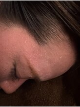 ハチ(Hachi)/顔からも大量発汗！