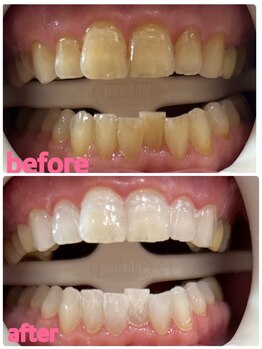 ホワイトニングセンター 浦添市役所前店/那覇市・浦添市・ホワイトニング