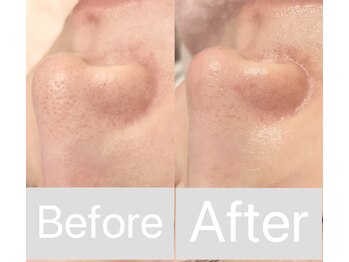 リンダ 西宮店(LINDA)/ハイドロ×プラズマ