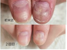 グレースレディ 大阪店/(深爪/長さだし/フィルイン/)