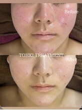 ヨサ モア(yosa more)/【10代顔の赤み】BeforeAfter