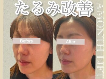 ミリュール(Millule)/4回の効果