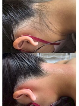 シルビー(CILBE)/うなじミックス脱毛