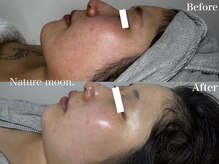 ナチュールムーン(Nature moon.)/ハーブピーリング